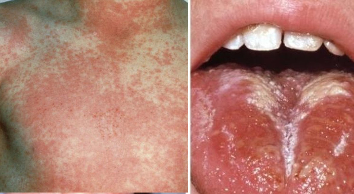 scarlet fever